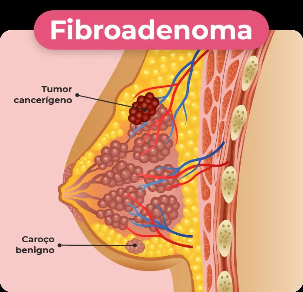 Ilustração mostra fibroadenoma e tumor cancerígeno na mama, destacando diferenças visuais entre nódulo benigno e maligno.