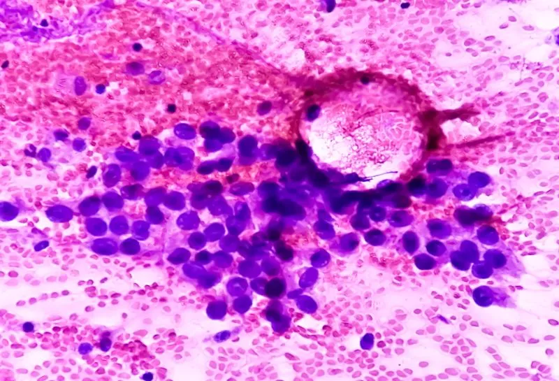 Imagem microscópica de células mamárias coradas por hematoxilina-eosina, destacando variações típicas de câncer de mama.
